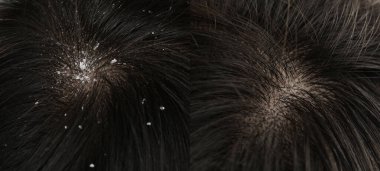 Kepek tedavisi öncesi ve sonrası saç gösteren bir kadın, kolaj.