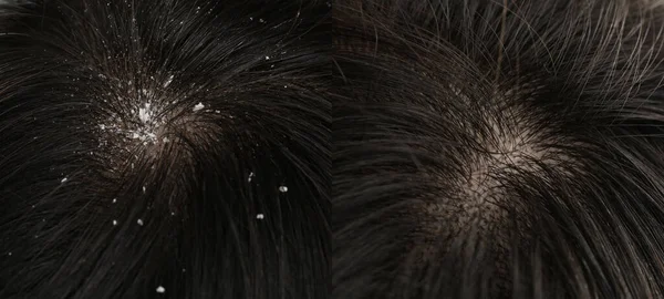 Kepek tedavisi öncesi ve sonrası saç gösteren bir kadın, kolaj.