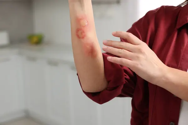 Woman with burns on her hand in kitchen, closeup. Space for text