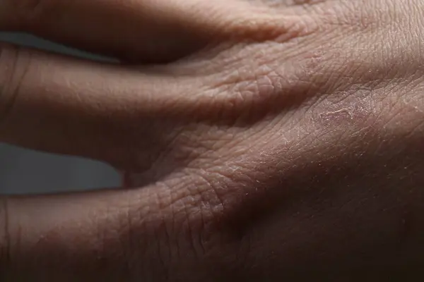 Woman with dry skin on hand, closeup