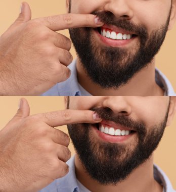 Bej arka planda tedavi öncesi ve sonrasında sakız gösteren adam, fotoğraf kolajı