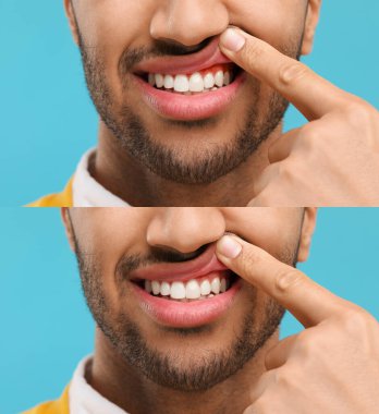 Açık mavi arkaplanda tedaviden önce ve sonra sakız gösteren adam, fotoğraf kolajı