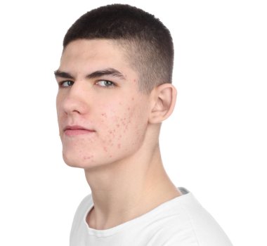 Sivilce sorunu olan genç bir adam beyazda izole edilmiş.