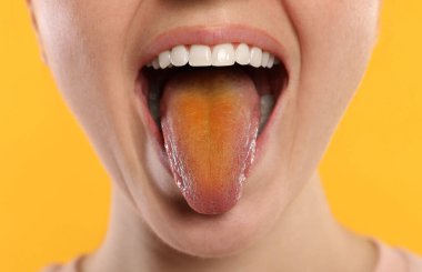 Gastrobağırsak hastalıkları. Kadın sarı dilini arka planda gösteriyor, yakın plan.