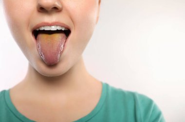 Gastrobağırsak hastalıkları. Beyaz arka planda sarı dilini gösteren kadın, yakın plan.
