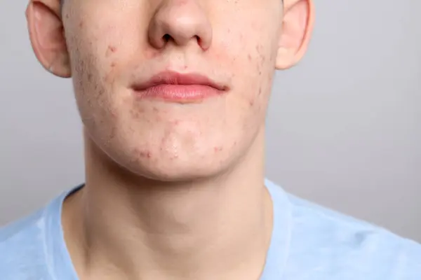 Mladý Muž Akné Problém Šedém Pozadí Detailní Záběr — Stock fotografie