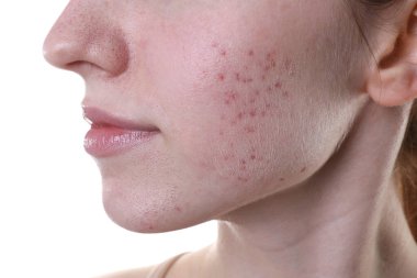 Beyaz arka planda akne sorunu olan genç kadın, closeup