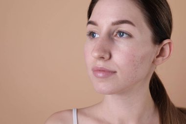 Bej arka planda sivilce sorunu olan genç bir kadın. Metin için boşluk
