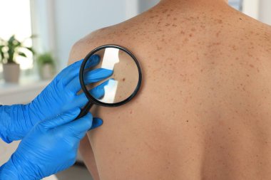 Dermatolog, klinikte büyüteçle hastanın doğum lekesini inceliyor.