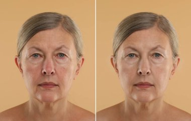 Yaşlanan deri değişir. Bej arka plandaki kozmetik prosedüründen önce ve sonra olgun kadın fotoğraflarıyla kolaj