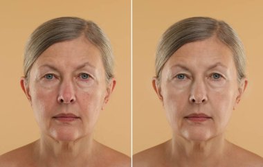 Aging skin changes. Collage with photos of mature woman before and after cosmetic procedure on beige background clipart