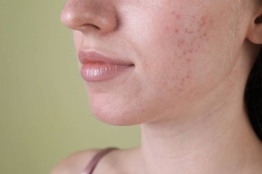 Zeytin arka planında sivilce sorunu olan genç bir kadın, yakın plan.