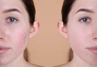 Acne problem. Young woman before and after treatment on beige background, closeup. Collage of photos clipart