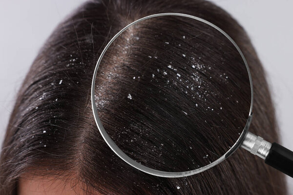Женщина, страдающая перхоти на светлом фоне, крупным планом. Вид через увеличительное стекло на волосы с хлопьями