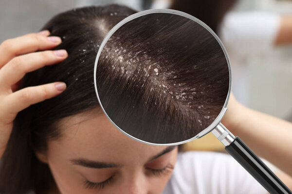 Женщина, страдающая перхоти на размытом фоне, крупным планом. Вид через увеличительное стекло на волосы с хлопьями
