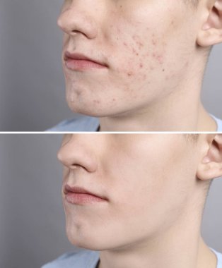 Sivilce sorunu. Gri arka planda tedavi öncesi ve sonrası genç adam, yakın plan. Fotoğraf Kolajı