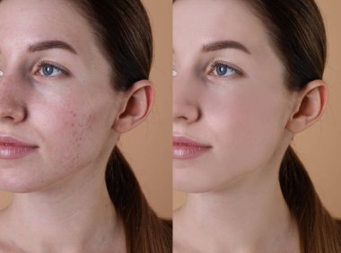 Acne problem. Young woman before and after treatment on beige background, collage of photos clipart