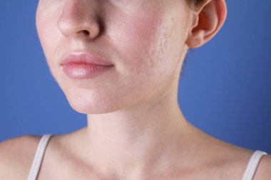 Mavi arka planda sivilce sorunu olan genç bir kadın, yakın plan.