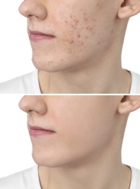 Sivilce sorunu. Tedaviden önce ve sonra beyaz arka planda genç adam, yakın plan. Fotoğraf Kolajı