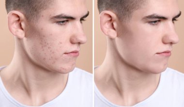 Sivilce sorunu. Bej arka planda tedaviden önce ve sonra genç adam, fotoğraf kolajı