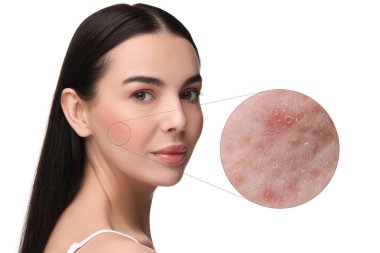 Dermatoloji. Beyaz arka planda deri sorunu olan bir kadın. Sivilceleri gösteren yakınlaştırılmış alan