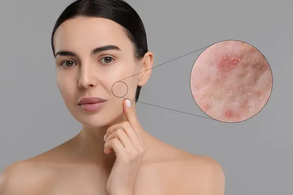 Stock image Dermatology. Woman with skin problem on grey background. Zoomed area showing acne