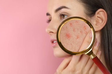 Dermatoloji. Pembe arka planda deri sorunu olan bir kadın. Sivilcelerdeki büyüteçle bak