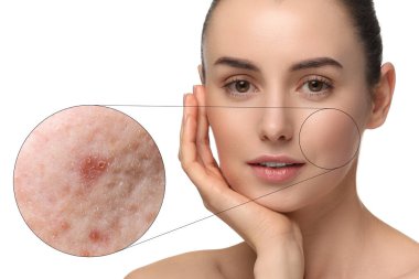 Dermatoloji. Beyaz arka planda deri sorunu olan bir kadın. Sivilceleri gösteren yakınlaştırılmış alan