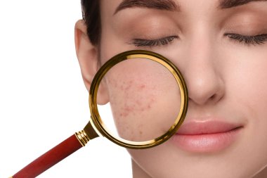 Dermatoloji. Beyaz arka planda deri sorunu olan bir kadın, yakın plan. Sivilcelerdeki büyüteçle bak