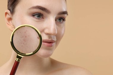Dermatoloji. Bej arka planda deri sorunu olan bir kadın, yakın plan. Sivilcelerdeki büyüteçle bak