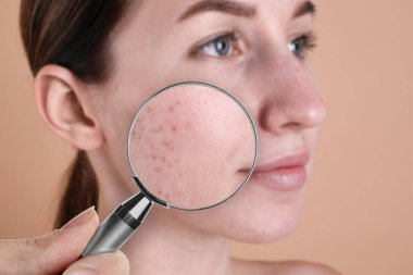 Dermatolog, arka planda büyüteçle kadının yüzüne bakıyor, yakın plan. Sivilceye yakınlaştırılmış görünüm