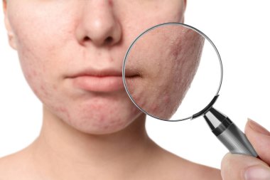 Dermatolog beyaz arka planda büyüteçle kadının yüzüne bakıyor. Sivilceye yakınlaştırılmış görünüm