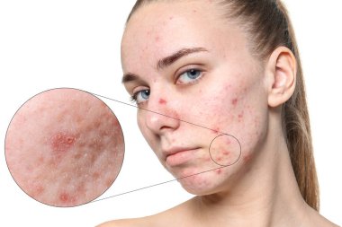 Dermatoloji. Beyaz arka planda deri sorunu olan bir kadın. Sivilceleri gösteren yakınlaştırılmış alan