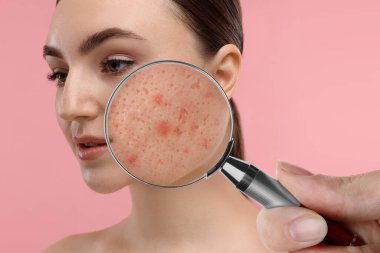 Dermatolog pembe arka planda büyüteçle kadının yüzüne bakıyor. Sivilceye yakınlaştırılmış görünüm