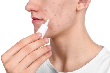 Akne sorunu olan genç bir adam beyaz arka planda cildine kozmetik ürünler uyguluyor.