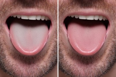 Man showing his tongue before and after cleaning procedure, closeup. Tongue coated with plaque on one side and healthy on other, collage clipart