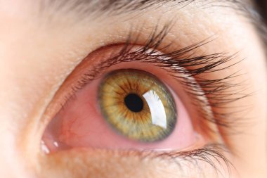 Kırmızı gözlü kadın konjonktivitten muzdarip, yakın plan