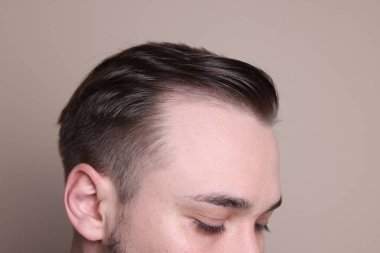 Kellik konsepti. Bej arka planda saç çizgisi olan adam, yakın plan.