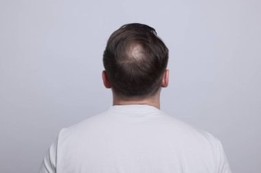 Kellik konsepti. Açık gri arka planda kel noktalı bir adam.