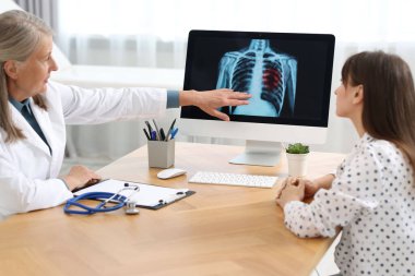 Akciğer kanseri. Doktor klinikteki hastasına göğüs röntgeni gösteriyor.