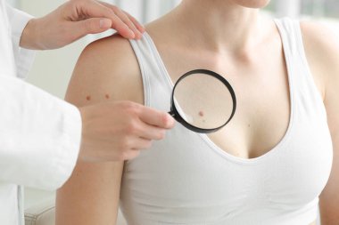 Klinikte büyüteçle kadının benini inceleyen doktor, yakın plan.