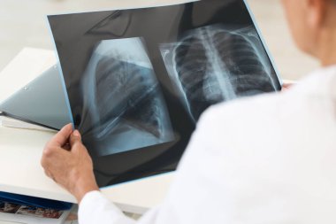 Akciğer hastalığı. Doktor klinikteki göğüs röntgenini inceliyor.