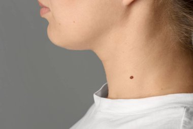 Cildinde gri arka planda ben olan kadın, yakın plan.