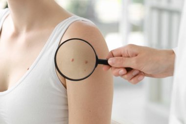 Klinikte büyüteçle kadının benini inceleyen doktor, yakın plan.