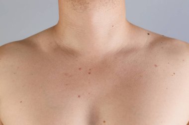 Cildinde gri arka planda doğum lekeleri olan bir adam, yakın plan.