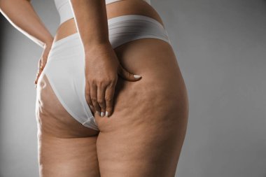 Gri arka planda selüliti olan kadın, yakın plan. Metin için boşluk