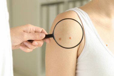 Klinikte büyüteçle kadının benini inceleyen doktor, yakın plan.