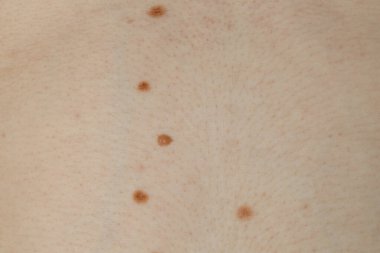 Cildinde doğum lekeleri olan bir adam, yakın plan.