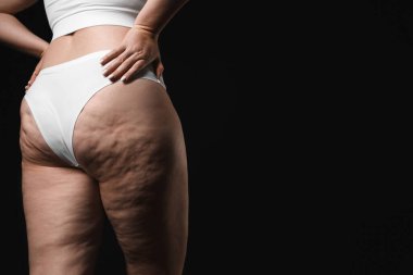 Siyah arka planda selüliti olan kadın, yakın plan. Metin için boşluk