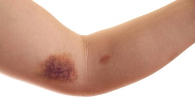 Kolunda morluk olan kadın beyaz arka planda, yakın plan.